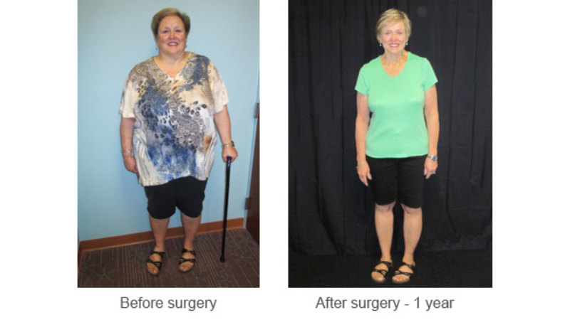 woman_before_after_surgery