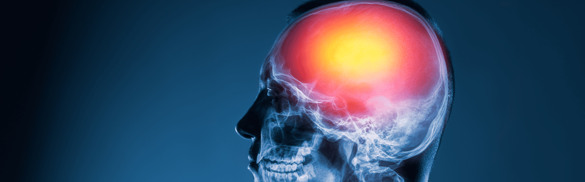 Research Chronic Stroke